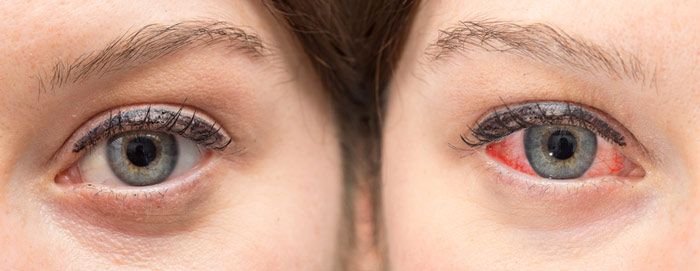 Antes y después del uso de gotas oftalmológicas para los ojos rojos